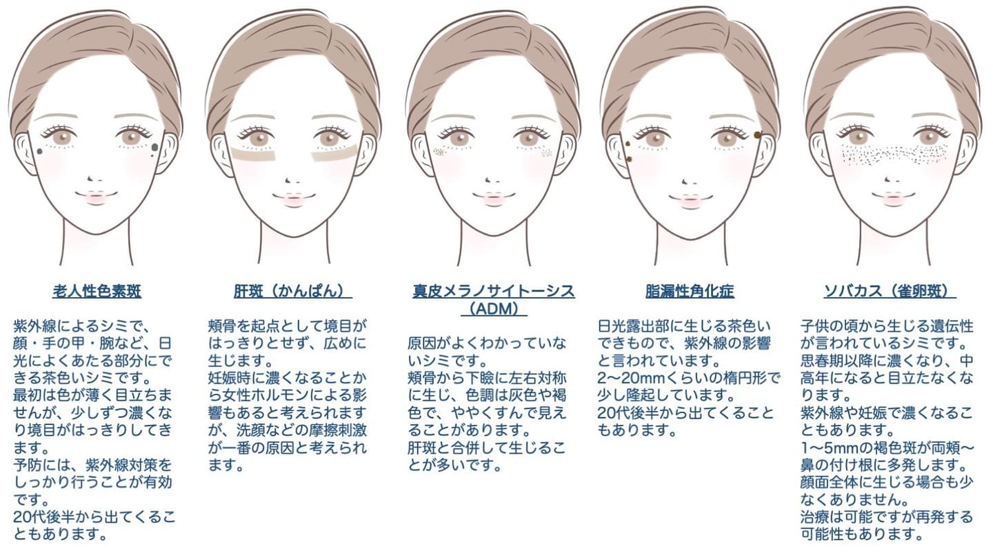 女性の顔のイラストにシミの種類をまとめた