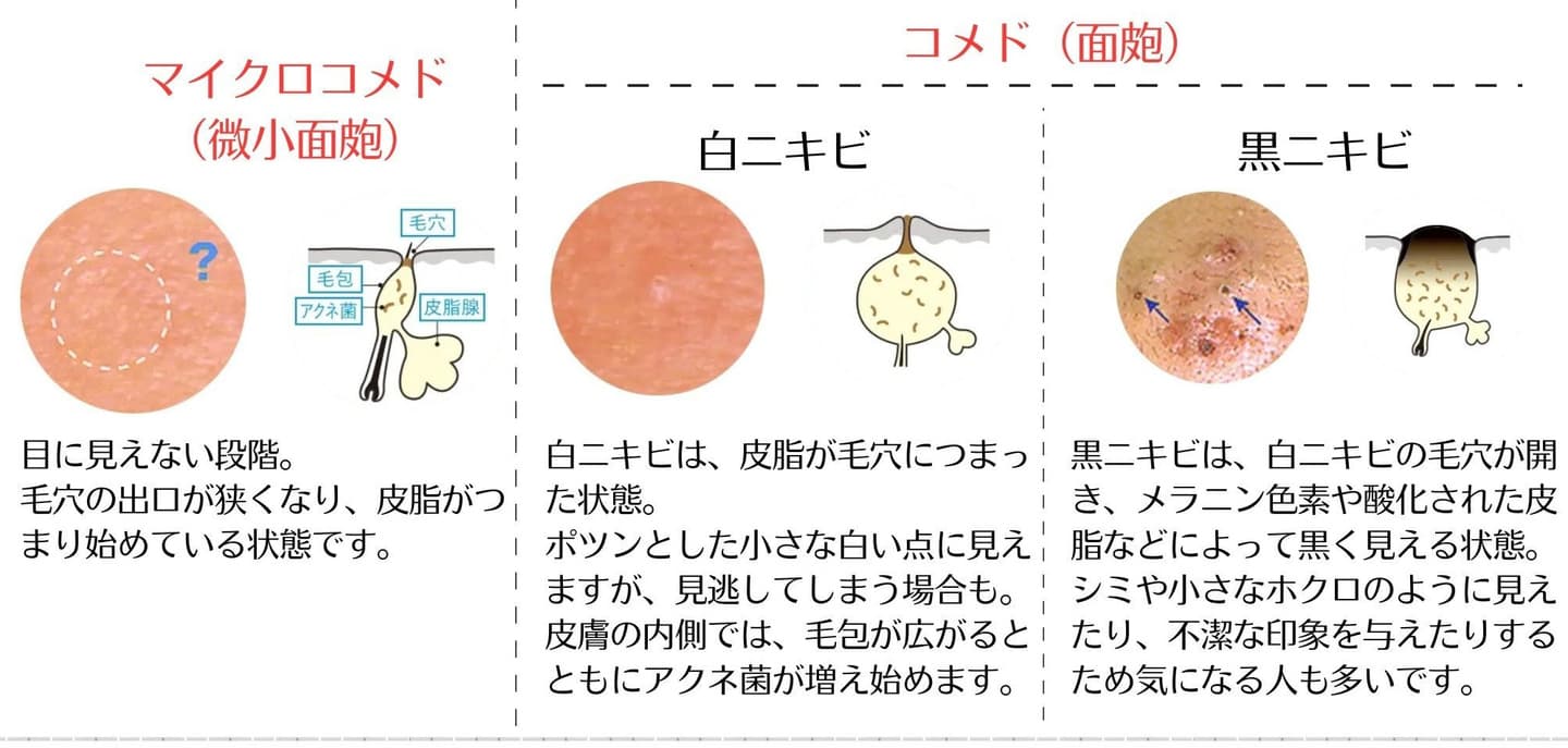 炎症のないニキビの説明イラスト