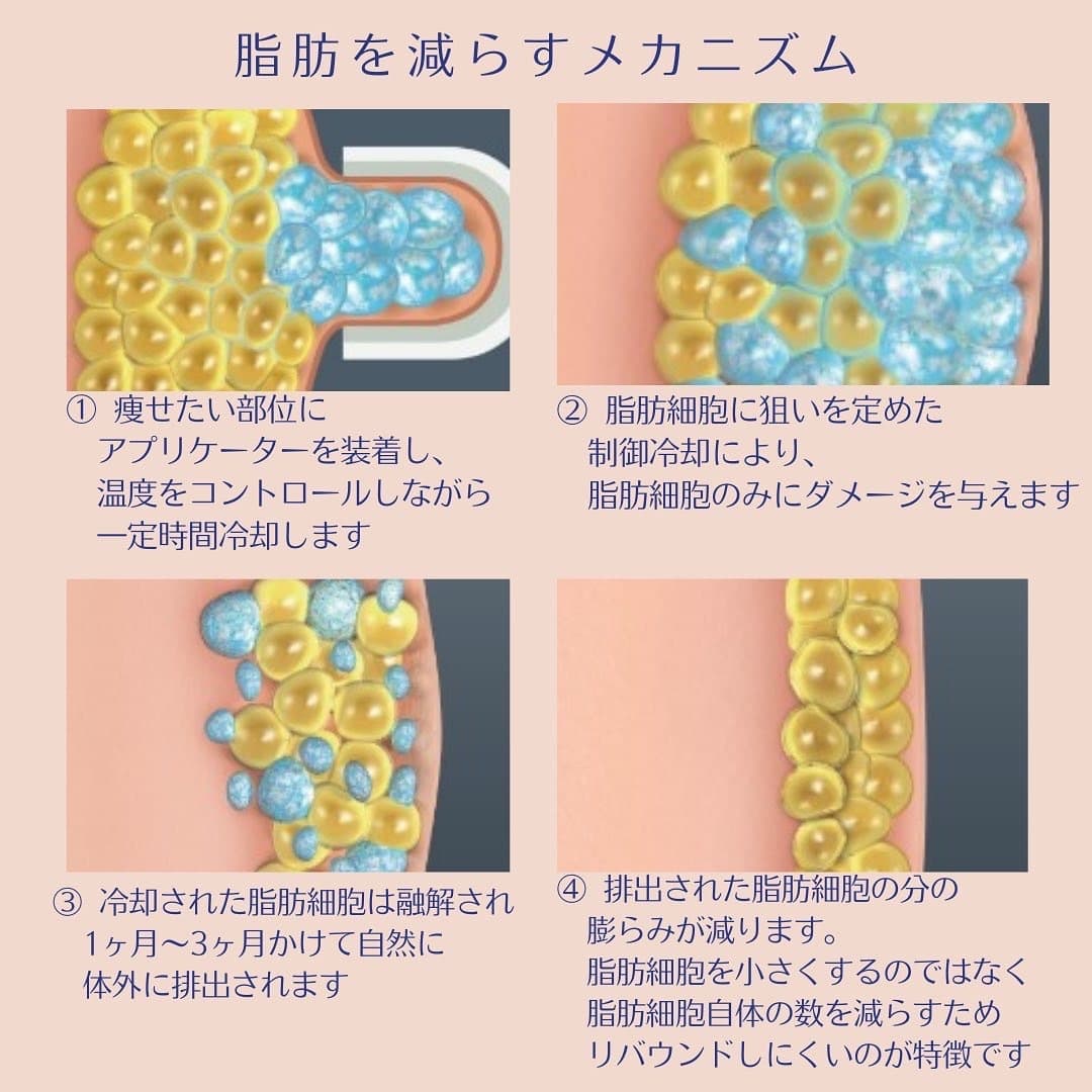 クールスカルプティングで痩せるメカニズムのイラスト