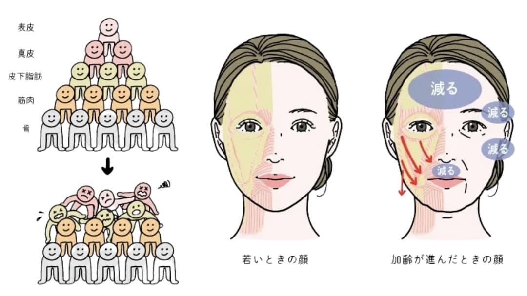 顔の脂肪の下垂についてのイラスト
