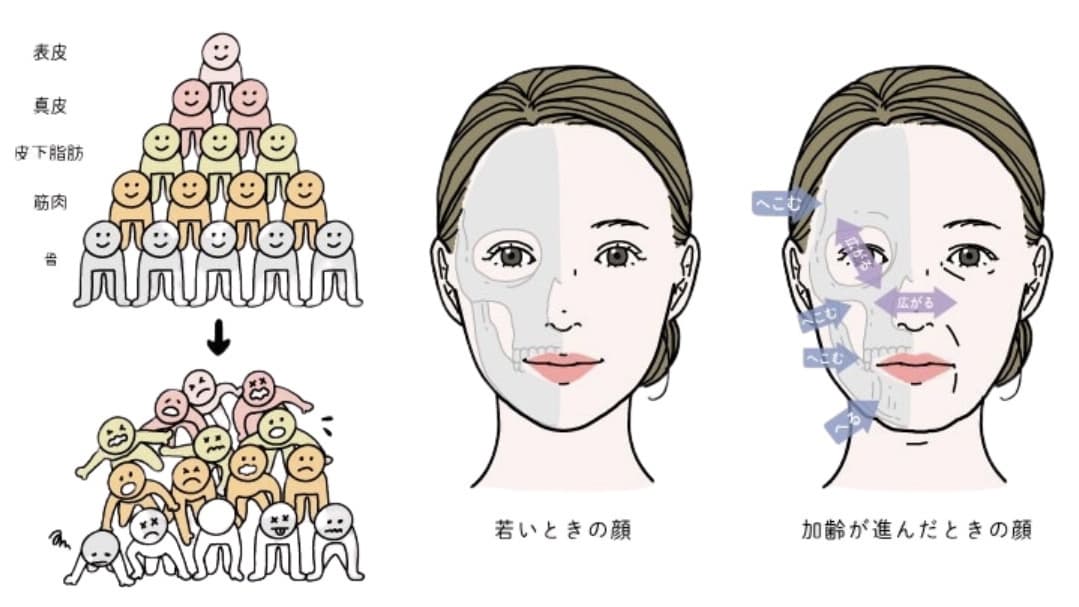 骨の萎縮についてのイラスト