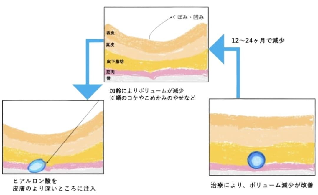 ヒアルロン酸の顔のボリュームアップをするイメージのイラスト