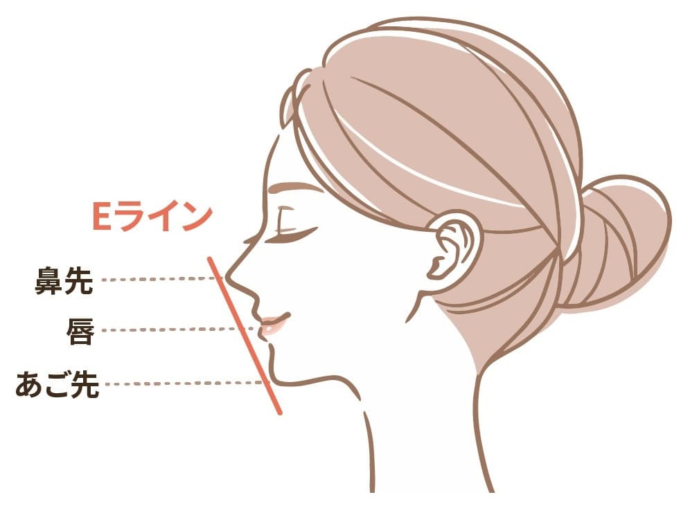 ヒアルロン酸をフェイスライン・顎の形成に使用するイラスト