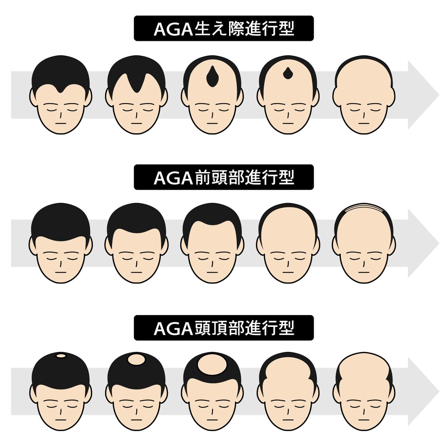 AGAの進行のしかたイラスト